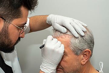 Can a Hair Transplant Improve Hair Density?