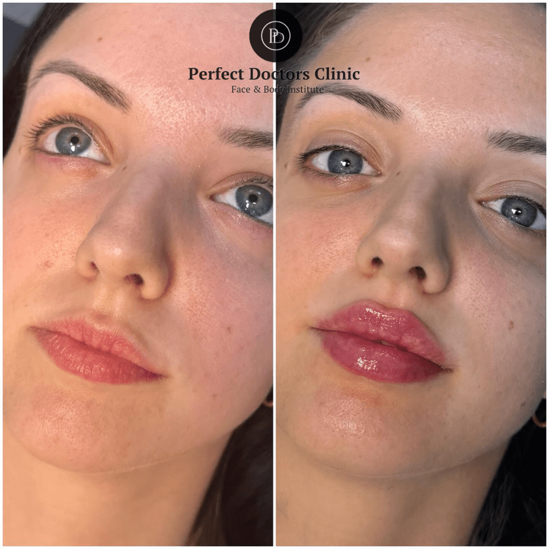 Top Juvederm Uses Explained by the Best Aesthetic Clinic in dubai