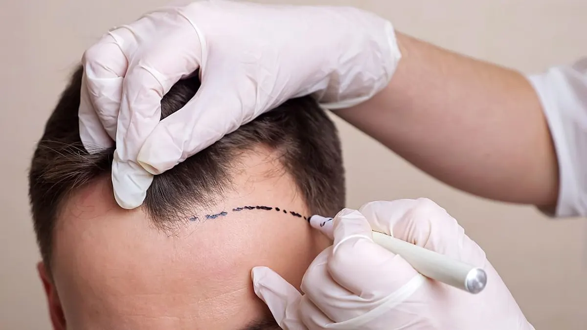 Hair Transplant Benefits: Regain Your Confidence