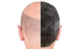 Non-Surgical Hair Loss Treatments in Dubai: Effective Solutions for Hair Restoration