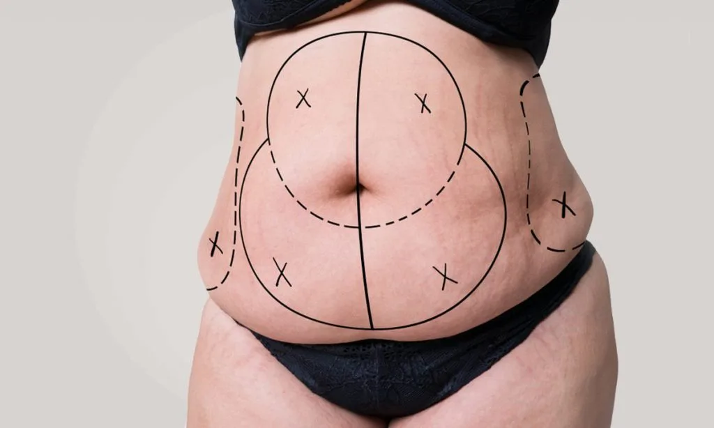 Liposuction Cost in Dubai