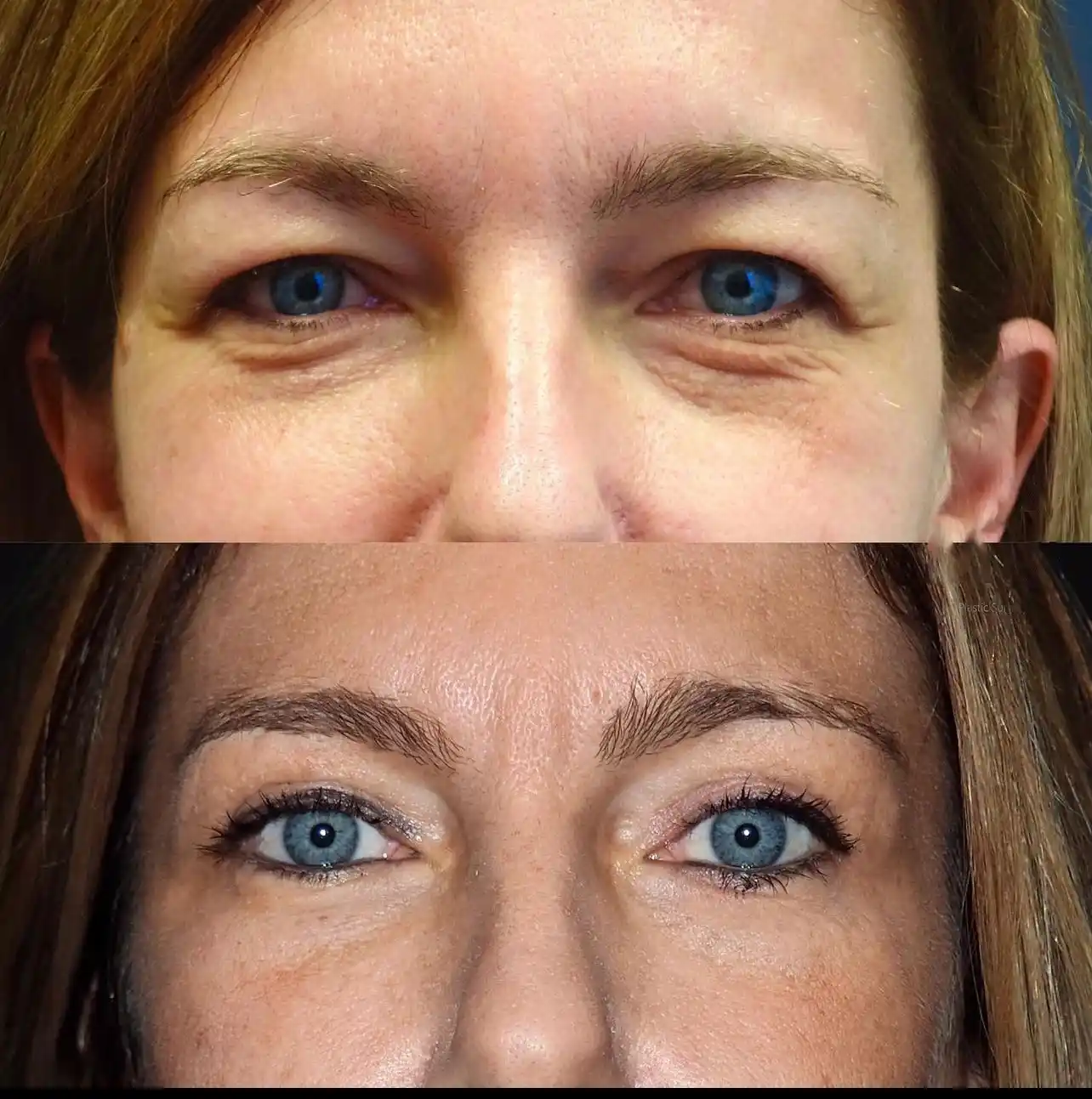 Eye bag removal in Dubai: The Importance of Customized Treatment Plans