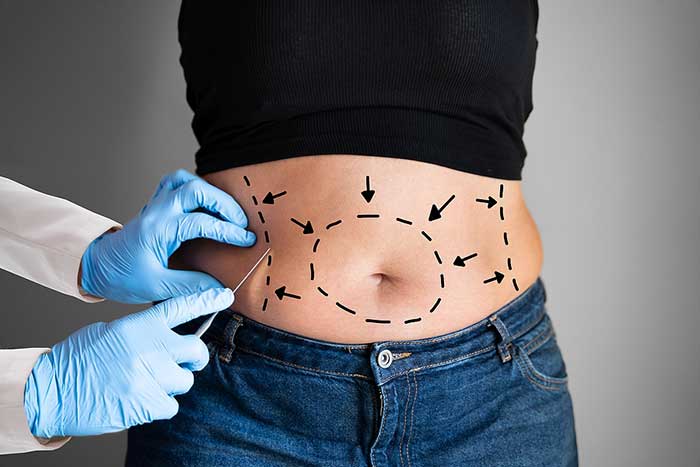 Liposuction Benefits: Body Shaping Explained