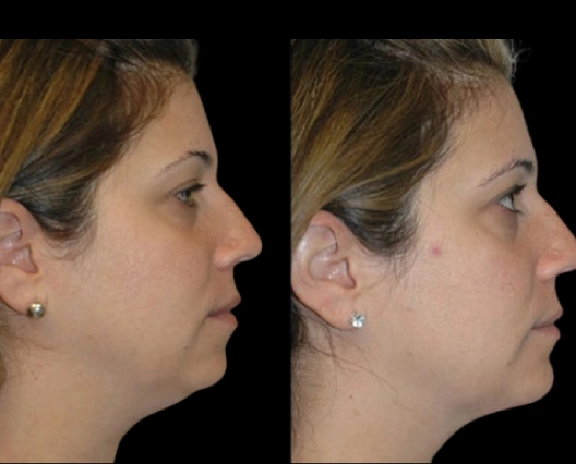 The Role of Technology in Procedures by the Best Double chin removal Surgeons in dubai