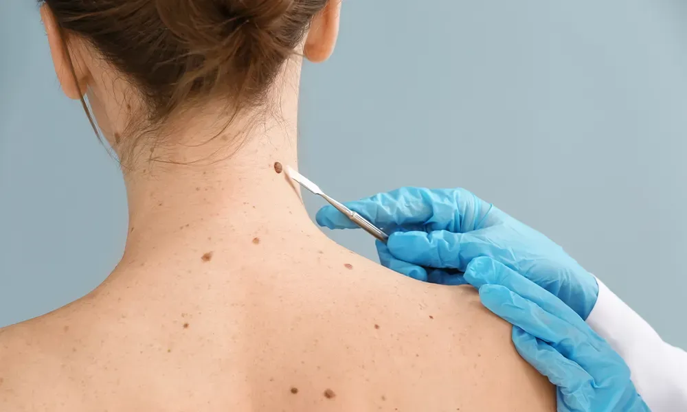 5 Ultimate Tips For Effective Skin Tag Removal Today