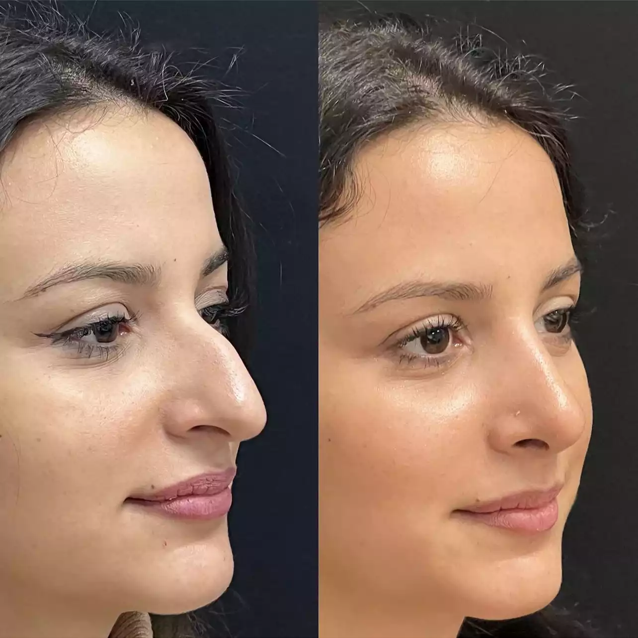 How to Choose the Best Rhinoplasty Surgeon in Dubai for Natural-Looking Results