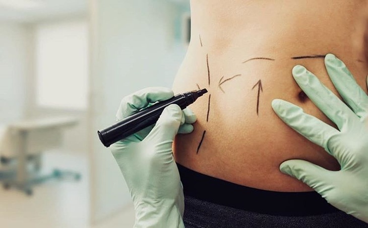 Liposuction Cost in Dubai