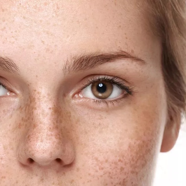 Melasma Treatment in Dubai