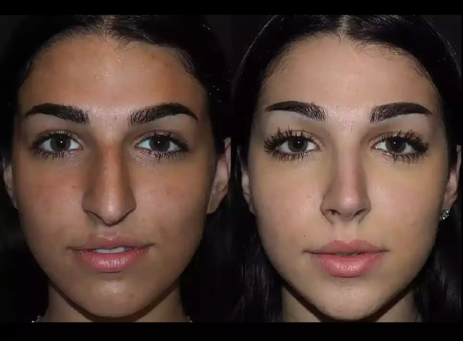 Rhinoplasty in Dubai: A Complete Guide to Nose Reshaping Surgery