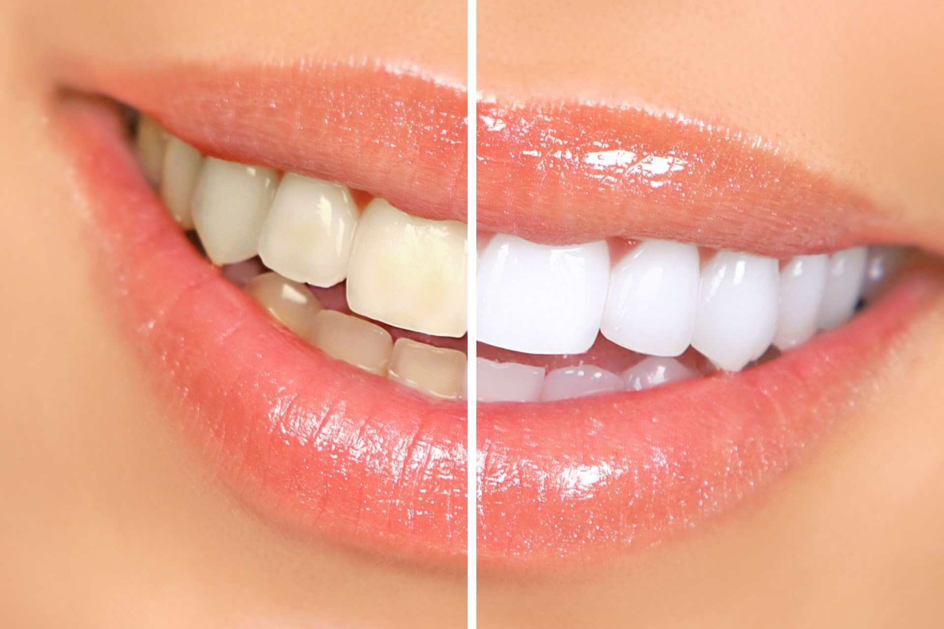 Teeth Whitening Price in Lahore & Finding the Best Dentist in Lahore