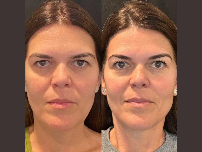 Thread Lift Treatments in Dubai for a Youthful Glow: Non-Invasive Skin Rejuvenation