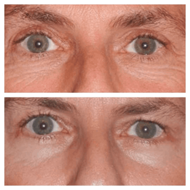 Does Eye bag removal Surgery in dubai Leave Scars?
