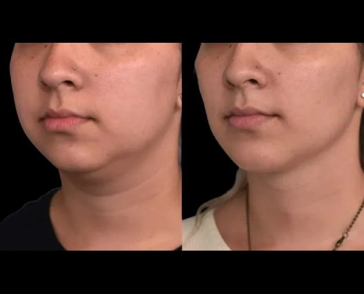 Does Double chin removal Surgery in dubai Affect Speech?