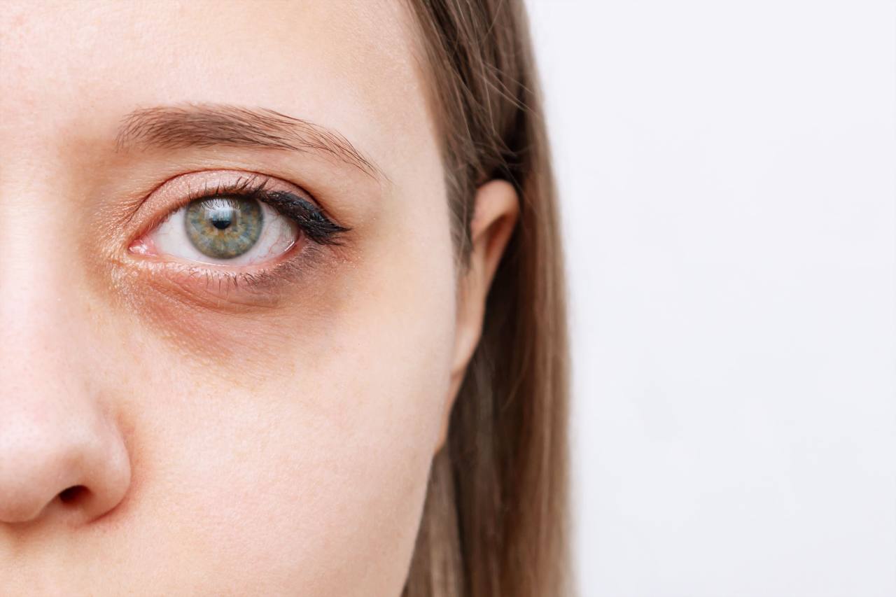 Dark Circles Treatment In Dubai