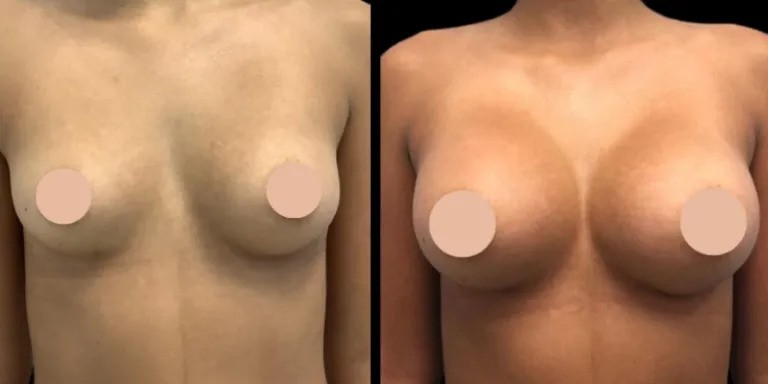 Breast Augmentation Recovery: Tips from the Best Doctors in Dubai