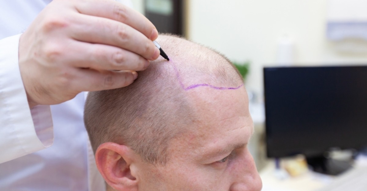 Hair Transplant in Dubai