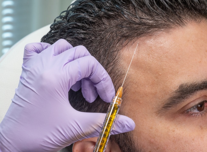 PRP Treatment Cost in Dubai