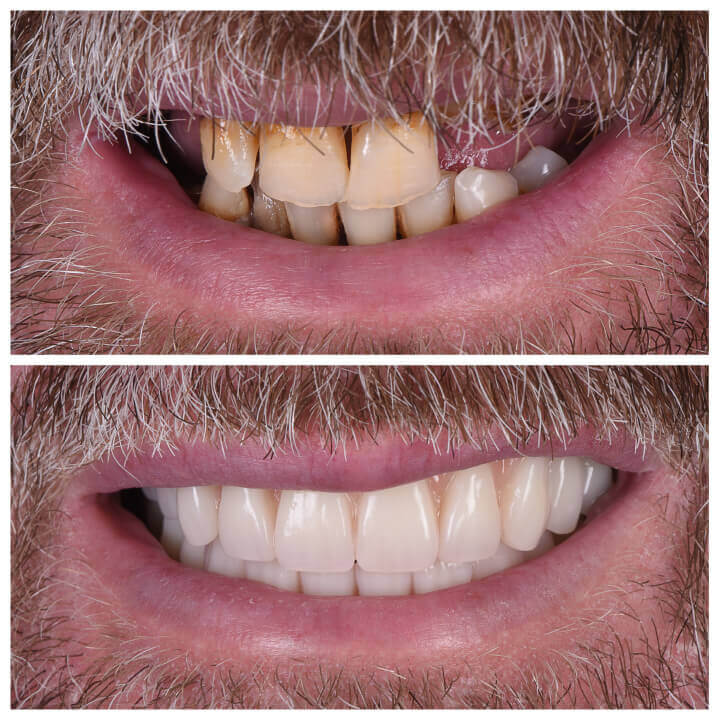 Transform Your Smile with Porcelain Veneers: A Lasting Solution for a Radiant Look