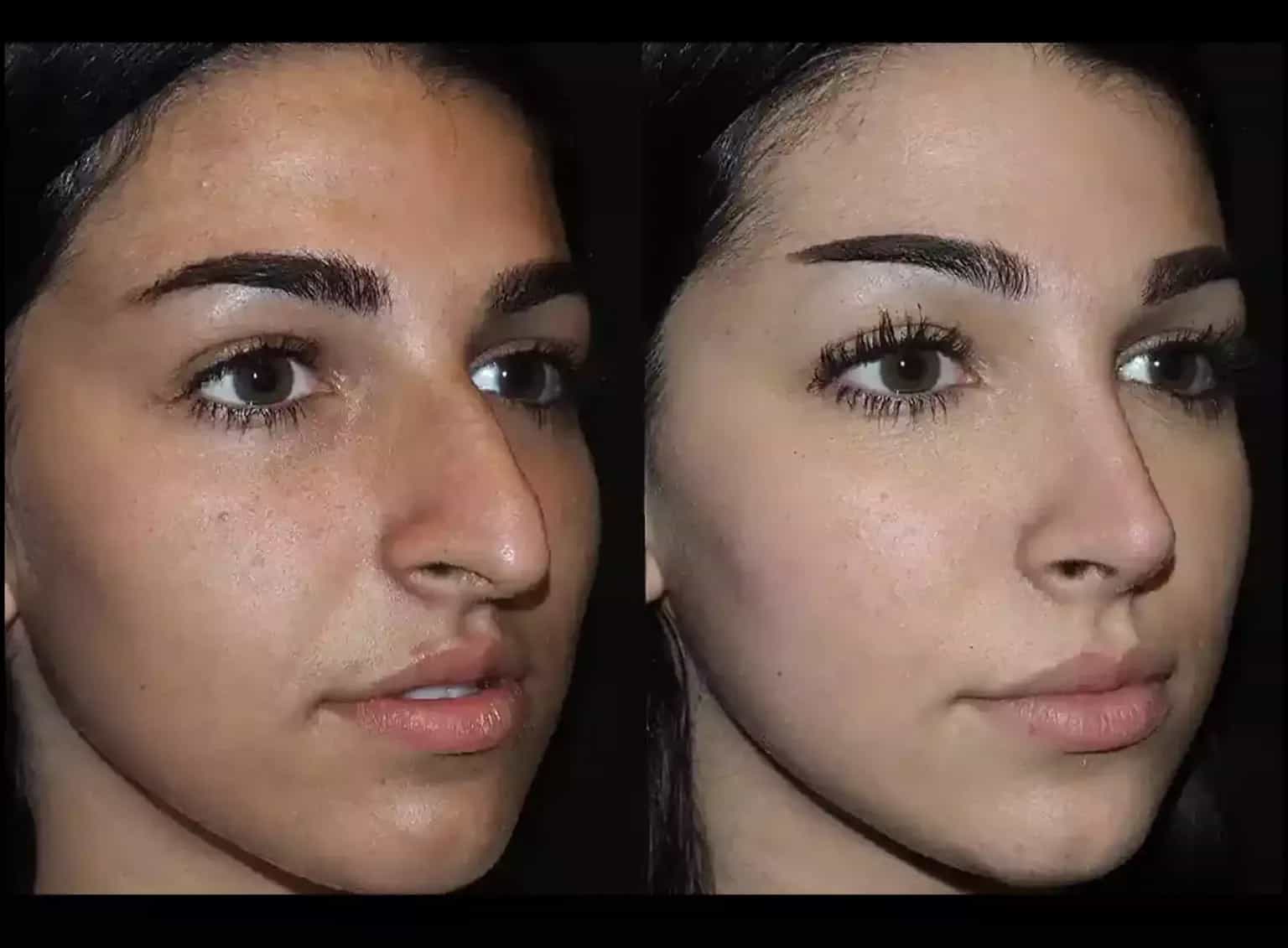 Medical Precision: Meet the Best Septoplasty Surgeon in Dubai
