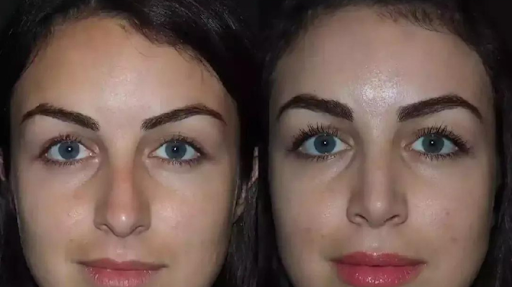 Why the Best Rhinoplasty Surgeon in Dubai Is in High Demand
