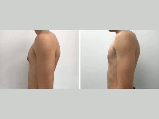 Life After Gynecomastia Surgery: Confidence and Lifestyle in Dubai