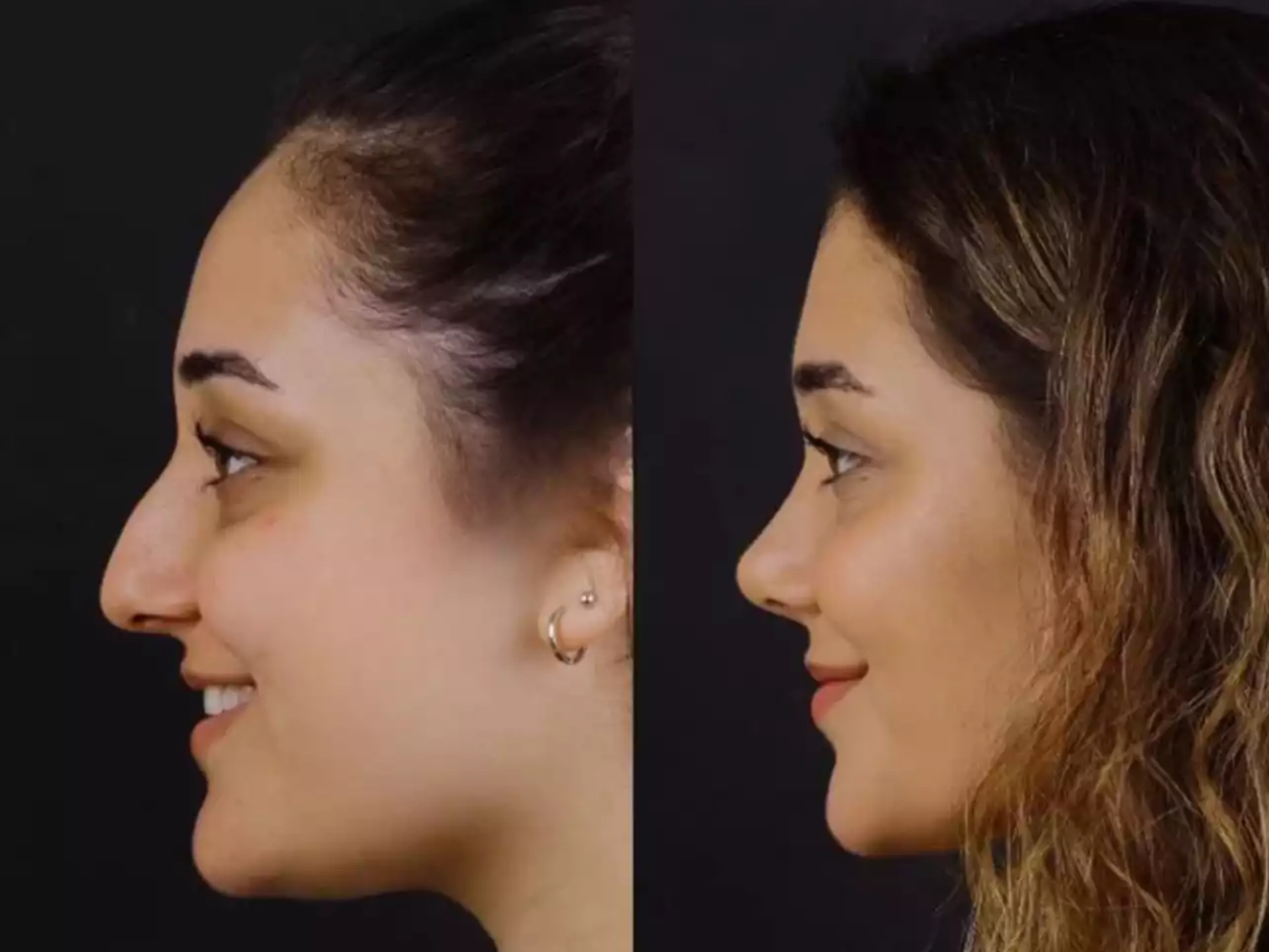 Breathe Freely Again: Best Doctors in Dubai for Septoplasty Surgery