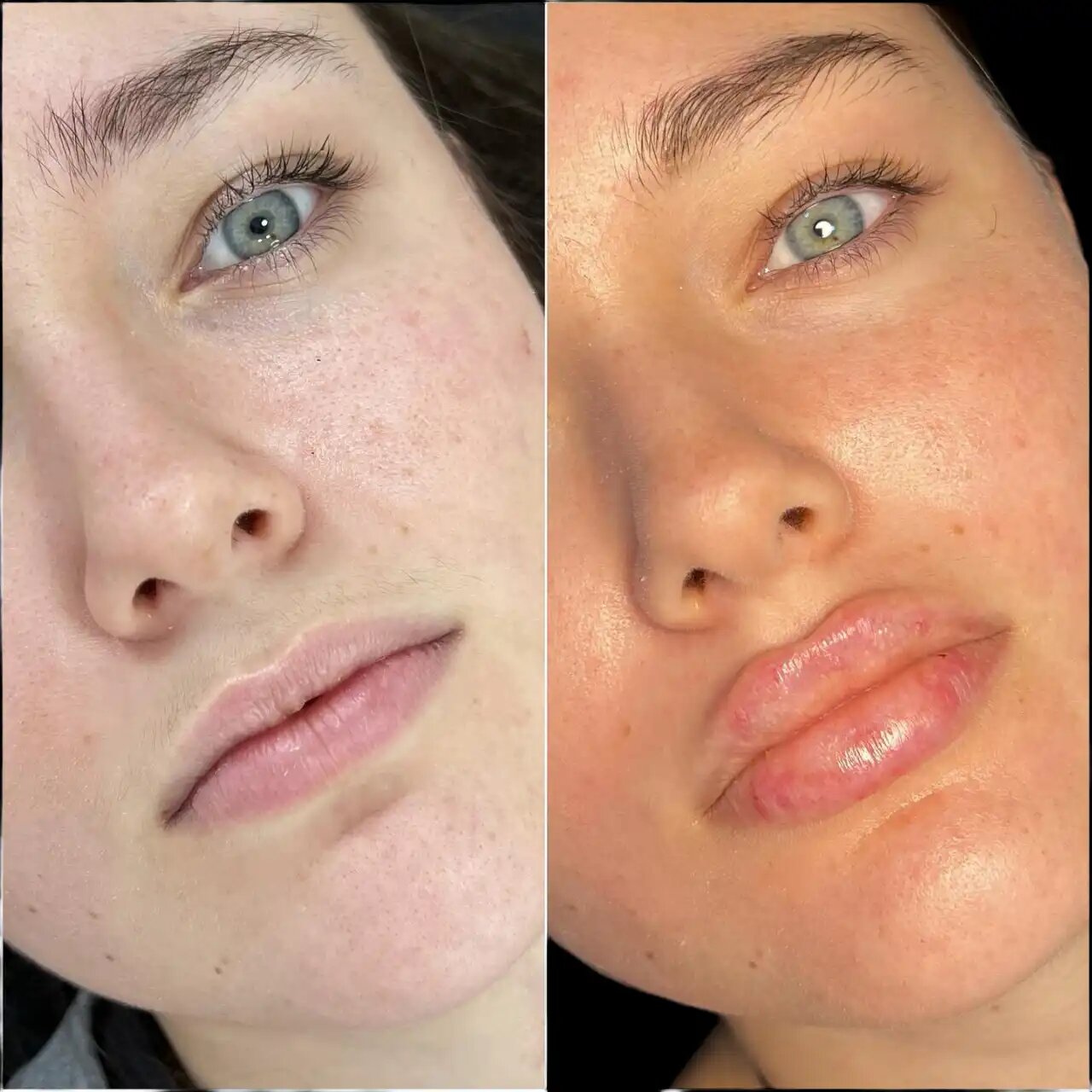Best Doctors in dubai for Fillers: How to Avoid Over-Treatment