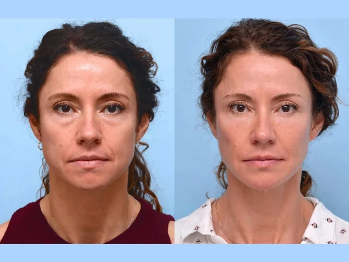 Best Plastic Surgeon in Dubai: The Recovery Process After a Thread Lift – What to Expect