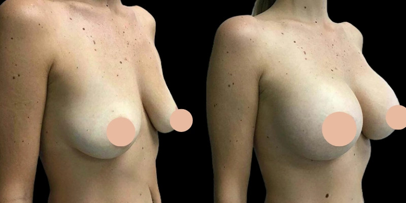 Breast Augmentation in Dubai: Cost, Procedure, and Recovery Explained