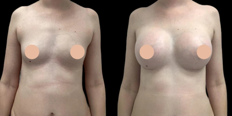 Flawless Results with the Best Breast Augmentation Surgeon in Dubai