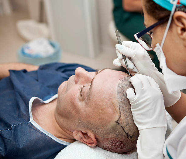 Hair Transplant in Riyadh