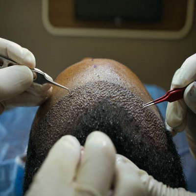 Hair transplant in Islamabad