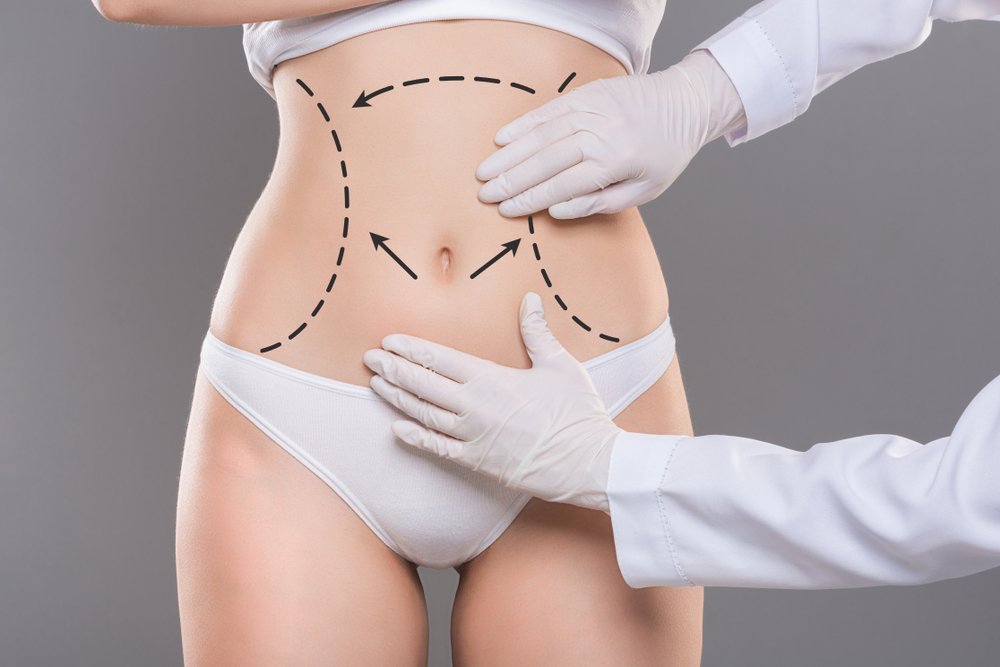Liposuction Cost in Dubai