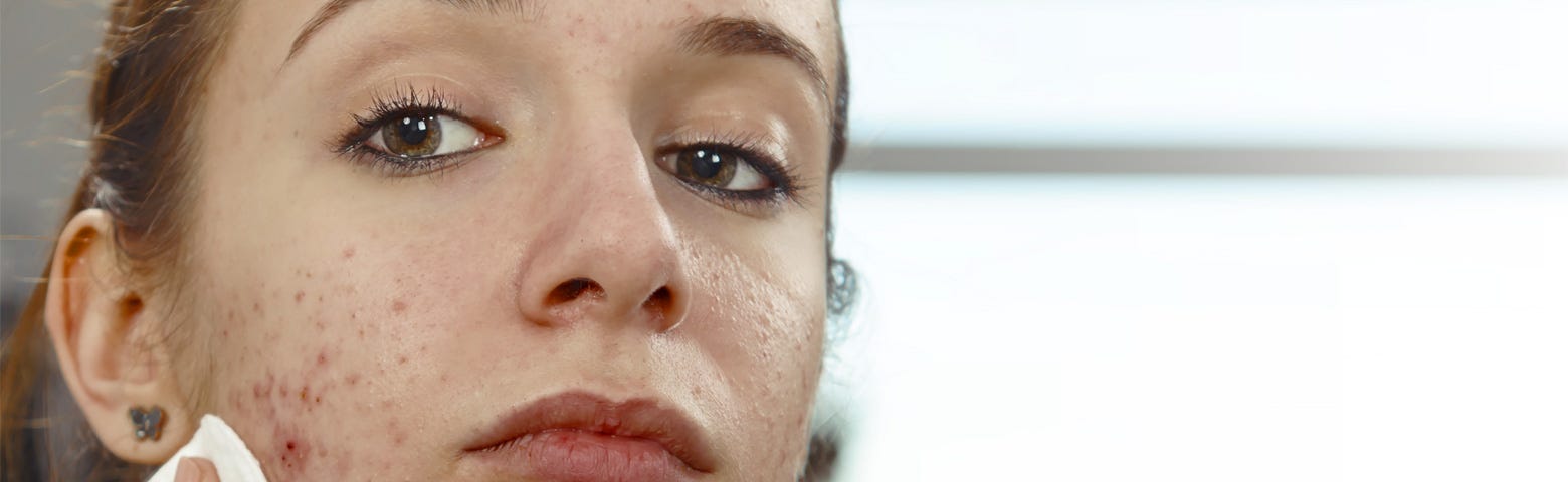 smoking weSmoking Weed Might Affect Your Skined cause hormonal acne