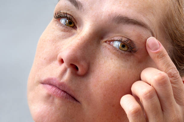 Does Blepharoplasty Help Eye Bags