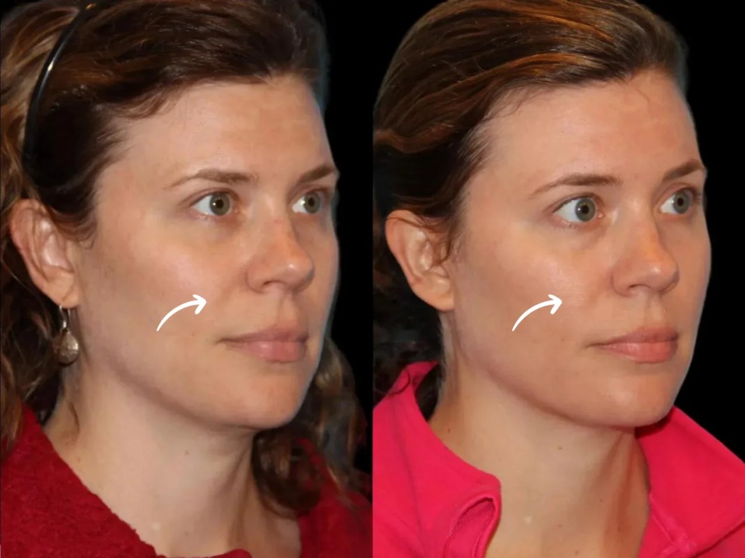 Non-Invasive Facial Lifts with Sculptra Fillers in Dubai