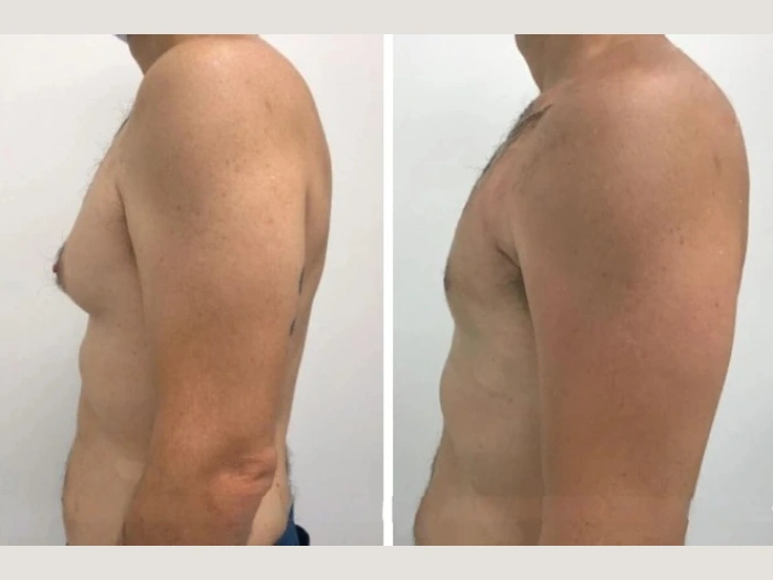 Gynecomastia Surgery in dubai
