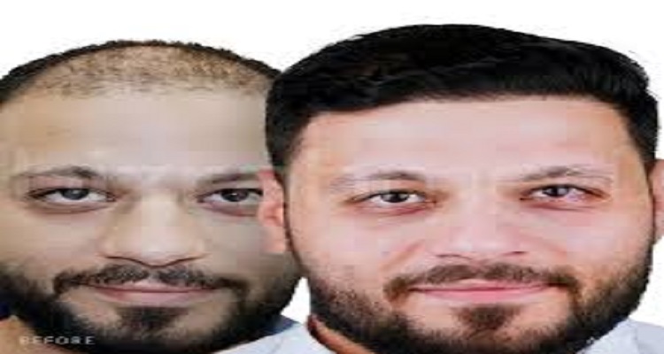 تجارب زراعة الشعر في الرياض: قصص حقيقية ونتائج مبهرة