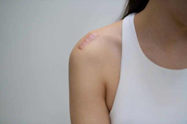 How Effective Is Keloid Treatment