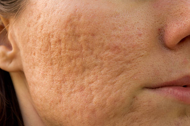 How to Close Pores Permanently After Acne