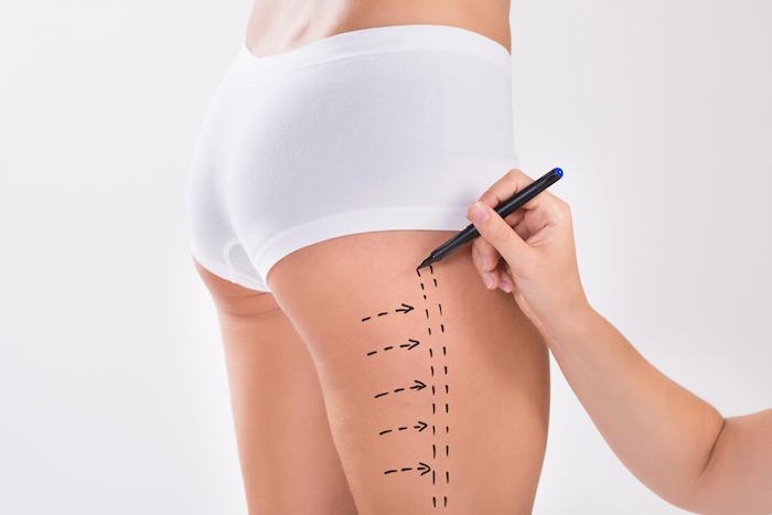 From Vision to Contour Best Liposuction Doctors in Dubai Turn Goals Into Reality