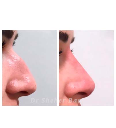 Rhinoplastic surgery Islamabad