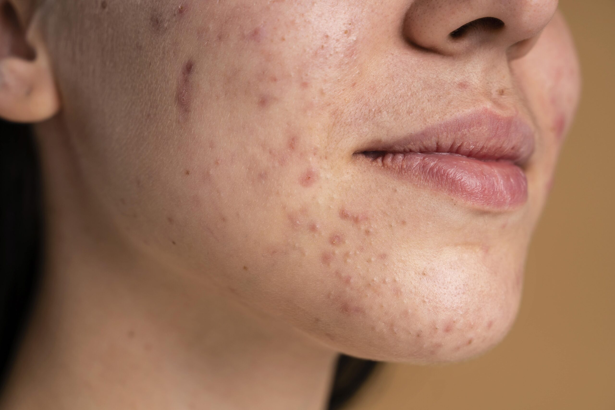Acne Treatment For Sensitive Skin