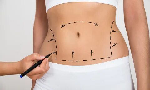 Liposuction NYC – Precision Fat Removal and Body Contouring in NYC