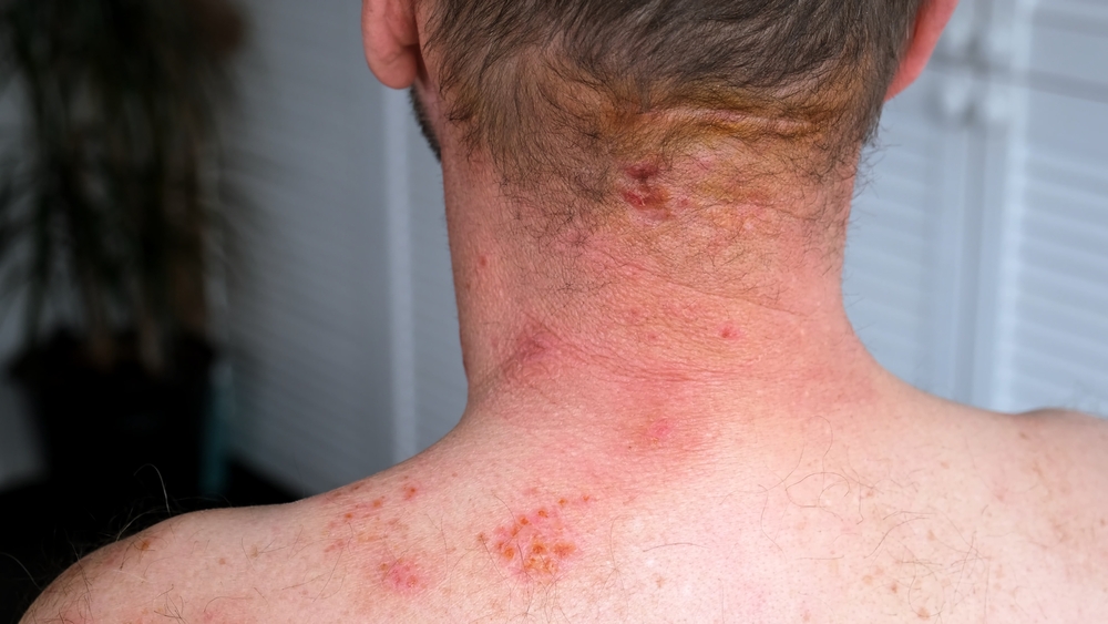 symptoms of eczema herpeticum