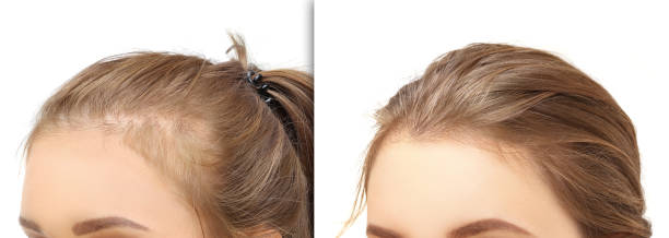 زراعة الشعر في الرياض: تقنيات حديثة ونتائج مضمونة بأقل وقت