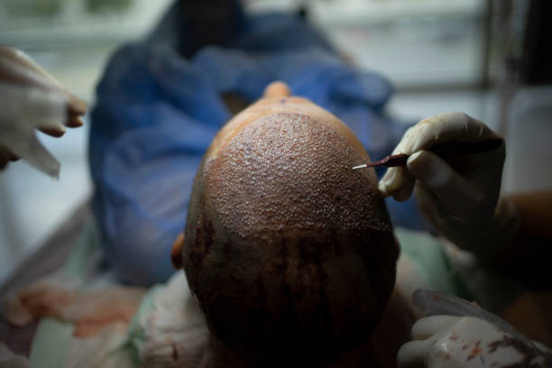 تكلفة زراعة الشعر في أبوظبي