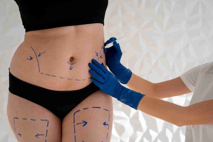 Key Differences Between Liposuction and Tummy Tuck