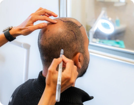 DHI hair transplant in Dubai