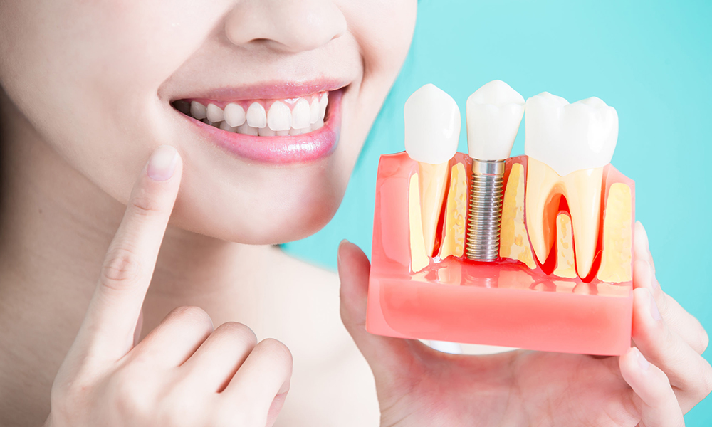 Dental Implants Istanbul